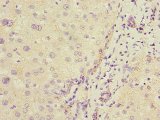 COMMD1 Antibody - Immunohistochemistry of paraffin-embedded human liver cancer at dilution 1:100