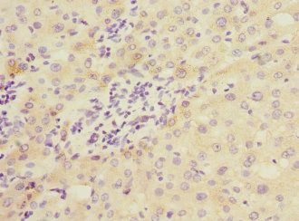 COMMD1 Antibody - Immunohistochemistry of paraffin-embedded human liver cancer at dilution 1:100