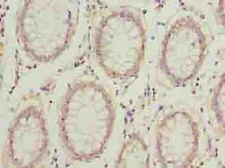COMMD2 Antibody - Immunohistochemistry of paraffin-embedded human colon cancer using antibody at dilution of 1:100.
