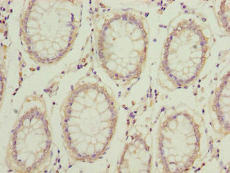 COMMD2 Antibody - Immunohistochemistry of paraffin-embedded human colon cancer using COMMD2 Antibody at dilution of 1:100
