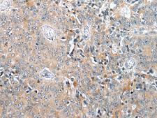 COMMD6 Antibody - Immunohistochemistry of paraffin-embedded Human prost at e cancer tissue  using COMMD6 Polyclonal Antibody at dilution of 1:45(×200)