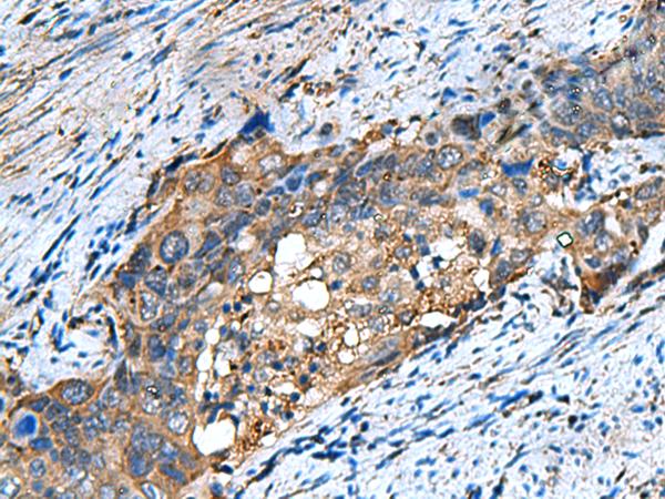 COMMD9 Antibody - Immunohistochemistry of paraffin-embedded Human cervical cancer tissue  using COMMD9 Polyclonal Antibody at dilution of 1:60(×200)