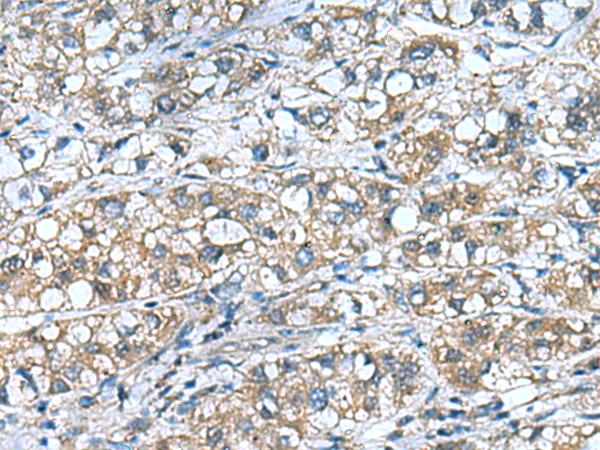 COMMD9 Antibody - Immunohistochemistry of paraffin-embedded Human liver cancer tissue  using COMMD9 Polyclonal Antibody at dilution of 1:55(×200)