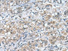 COMMD9 Antibody - Immunohistochemistry of paraffin-embedded Human liver cancer tissue  using COMMD9 Polyclonal Antibody at dilution of 1:55(×200)