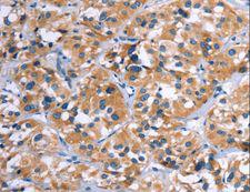 COMP / THBS5 Antibody - Immunohistochemistry of paraffin-embedded Human thyroid cancer using COMP Polyclonal Antibody at dilution of 1:50.