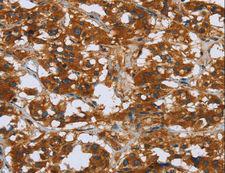 COMP / THBS5 Antibody - Immunohistochemistry of paraffin-embedded Human breast cancer using COMP Polyclonal Antibody at dilution of 1:50.