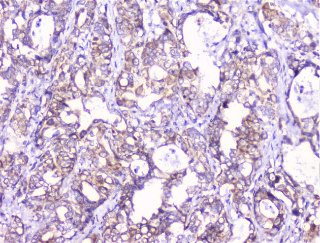 COMP / THBS5 Antibody - IHC analysis of COMP using anti-COMP antibody. COMP was detected in paraffin-embedded section of human gastric cancer tissue. Heat mediated antigen retrieval was performed in citrate buffer (pH6, epitope retrieval solution) for 20 mins. The tissue section was blocked with 10% goat serum. The tissue section was then incubated with 1µg/ml rabbit anti-COMP Antibody overnight at 4°C. Biotinylated goat anti-rabbit IgG was used as secondary antibody and incubated for 30 minutes at 37°C. The tissue section was developed using Strepavidin-Biotin-Complex (SABC) with DAB as the chromogen.