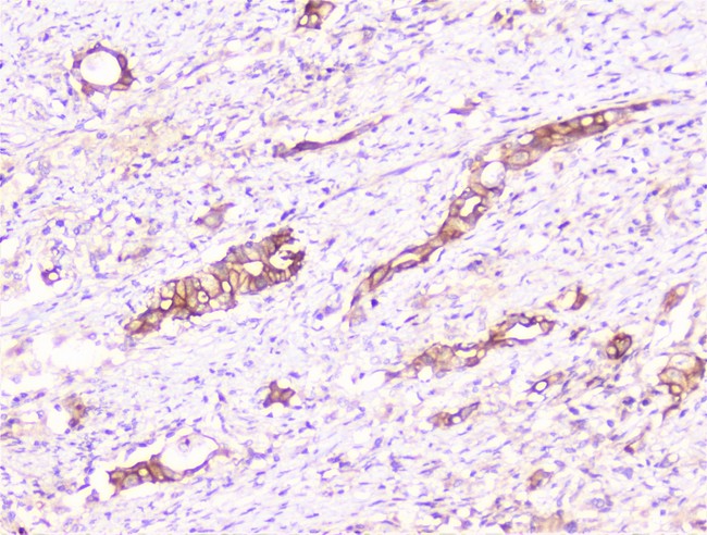 COMP / THBS5 Antibody - IHC analysis of COMP using anti-COMP antibody. COMP was detected in paraffin-embedded section of human intestinal cancer tissue. Heat mediated antigen retrieval was performed in citrate buffer (pH6, epitope retrieval solution) for 20 mins. The tissue section was blocked with 10% goat serum. The tissue section was then incubated with 1µg/ml rabbit anti-COMP Antibody overnight at 4°C. Biotinylated goat anti-rabbit IgG was used as secondary antibody and incubated for 30 minutes at 37°C. The tissue section was developed using Strepavidin-Biotin-Complex (SABC) with DAB as the chromogen.