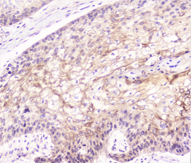 COMP / THBS5 Antibody - IHC analysis of COMP using anti-COMP antibody. COMP was detected in paraffin-embedded section of human oesophagus squama cancer tissue. Heat mediated antigen retrieval was performed in citrate buffer (pH6, epitope retrieval solution) for 20 mins. The tissue section was blocked with 10% goat serum. The tissue section was then incubated with 1µg/ml rabbit anti-COMP Antibody overnight at 4°C. Biotinylated goat anti-rabbit IgG was used as secondary antibody and incubated for 30 minutes at 37°C. The tissue section was developed using Strepavidin-Biotin-Complex (SABC) with DAB as the chromogen.
