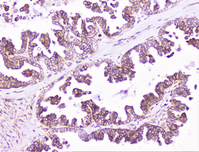 COMP / THBS5 Antibody - IHC analysis of COMP using anti-COMP antibody. COMP was detected in paraffin-embedded section of human ovary cancer tissue. Heat mediated antigen retrieval was performed in citrate buffer (pH6, epitope retrieval solution) for 20 mins. The tissue section was blocked with 10% goat serum. The tissue section was then incubated with 1µg/ml rabbit anti-COMP Antibody overnight at 4°C. Biotinylated goat anti-rabbit IgG was used as secondary antibody and incubated for 30 minutes at 37°C. The tissue section was developed using Strepavidin-Biotin-Complex (SABC) with DAB as the chromogen.