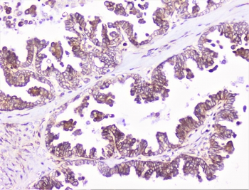 COMP / THBS5 Antibody - IHC staining of FFPE human ovarian cancer with COMP antibody at 1ug/ml. HIER: boil tissue sections in pH6, 10mM citrate buffer, for 10-20 min followed by cooling at RT for 20 min.
