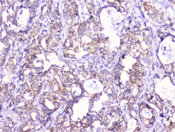 COMP / THBS5 Antibody - IHC staining of FFPE human stomach cancer with COMP antibody at 1ug/ml. HIER: boil tissue sections in pH6, 10mM citrate buffer, for 10-20 min followed by cooling at RT for 20 min.