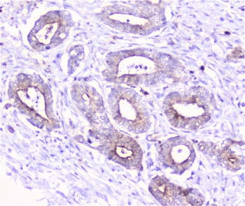 COMP / THBS5 Antibody - IHC staining of FFPE human cholangiocarcinoma cancer with COMP antibody at 1ug/ml. HIER: boil tissue sections in pH6, 10mM citrate buffer, for 10-20 min followed by cooling at RT for 20 min.