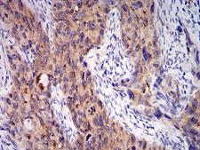 Complement C1QA Antibody - Immunohistochemical analysis of paraffin-embedded cervical cancer tissues using C1QA mouse mAb with DAB staining.