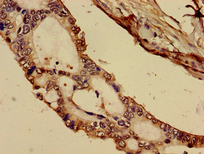Complement C1R Antibody - Immunohistochemistry image of paraffin-embedded human pancreatic cancer at a dilution of 1:100