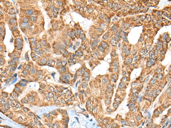 Complement C1R Antibody - Immunohistochemistry of paraffin-embedded Human thyroid cancer tissue  using C1R Polyclonal Antibody at dilution of 1:70(×200)
