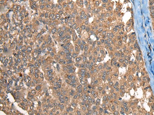 Complement C1R Antibody - Immunohistochemistry of paraffin-embedded Human liver cancer tissue  using C1R Polyclonal Antibody at dilution of 1:40(×200)