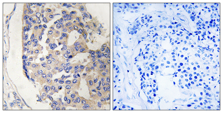 Complement C1s Antibody - Immunohistochemistry analysis of paraffin-embedded human breast carcinoma tissue, using C1S Antibody. The picture on the right is blocked with the synthesized peptide.