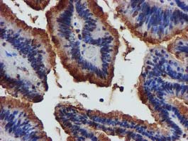 Complement C1s Antibody - IHC of paraffin-embedded Adenocarcinoma of Human colon tissue using anti-C1S mouse monoclonal antibody. (Heat-induced epitope retrieval by 10mM citric buffer, pH6.0, 100C for 10min).