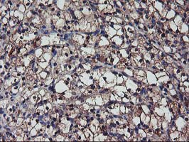 Complement C1s Antibody - IHC of paraffin-embedded Carcinoma of Human kidney tissue using anti-C1S mouse monoclonal antibody. (Heat-induced epitope retrieval by 10mM citric buffer, pH6.0, 100C for 10min).