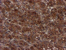 Complement C1s Antibody - IHC of paraffin-embedded Carcinoma of Human liver tissue using anti-C1S mouse monoclonal antibody. (Heat-induced epitope retrieval by 10mM citric buffer, pH6.0, 100C for 10min).