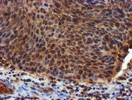 Complement C1s Antibody - IHC of paraffin-embedded Carcinoma of Human bladder tissue using anti-C1S mouse monoclonal antibody. (Heat-induced epitope retrieval by 10mM citric buffer, pH6.0, 100C for 10min).