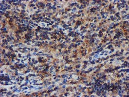 Complement C1s Antibody - IHC of paraffin-embedded Human lymphoma tissue using anti-C1S mouse monoclonal antibody. (Heat-induced epitope retrieval by 10mM citric buffer, pH6.0, 100C for 10min).