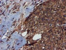 Complement C1s Antibody - IHC of paraffin-embedded Adenocarcinoma of Human breast tissue using anti-C1S mouse monoclonal antibody.