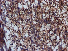 Complement C1s Antibody - IHC of paraffin-embedded Carcinoma of Human kidney tissue using anti-C1S mouse monoclonal antibody.