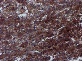 Complement C1s Antibody - IHC of paraffin-embedded Carcinoma of Human liver tissue using anti-C1S mouse monoclonal antibody.