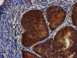 Complement C1s Antibody - IHC of paraffin-embedded Adenocarcinoma of Human endometrium tissue using anti-C1S mouse monoclonal antibody.
