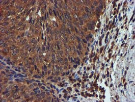Complement C1s Antibody - IHC of paraffin-embedded Carcinoma of Human bladder tissue using anti-C1S mouse monoclonal antibody.