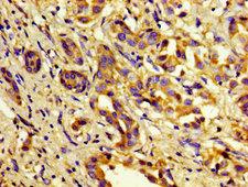 Complement C1s Antibody - Immunohistochemistry image of paraffin-embedded human liver cancer at a dilution of 1:100