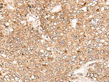 Complement C1s Antibody - Immunohistochemistry of paraffin-embedded Human liver cancer tissue  using C1S Polyclonal Antibody at dilution of 1:55(×200)