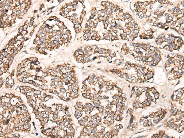 Complement C1s Antibody - Immunohistochemistry of paraffin-embedded Human esophagus cancer tissue  using C1S Polyclonal Antibody at dilution of 1:55(×200)