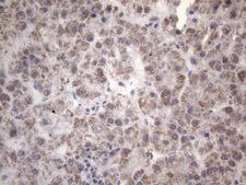 Complement C2 Antibody - Immunohistochemical staining of paraffin-embedded Carcinoma of Human liver tissue using anti-C2 mouse monoclonal antibody. (Heat-induced epitope retrieval by 1mM EDTA in 10mM Tris buffer. (pH8.5) at 120°C for 3 min. (1:150)