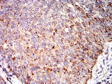 Complement C3 Antibody - Immunohistochemical analysis of paraffin-embedded bladder cancer tissues using C3C mouse mAb with DAB staining.