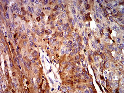 Complement C3 Antibody - Immunohistochemical analysis of paraffin-embedded ovarian cancer tissues using C3C mouse mAb with DAB staining.