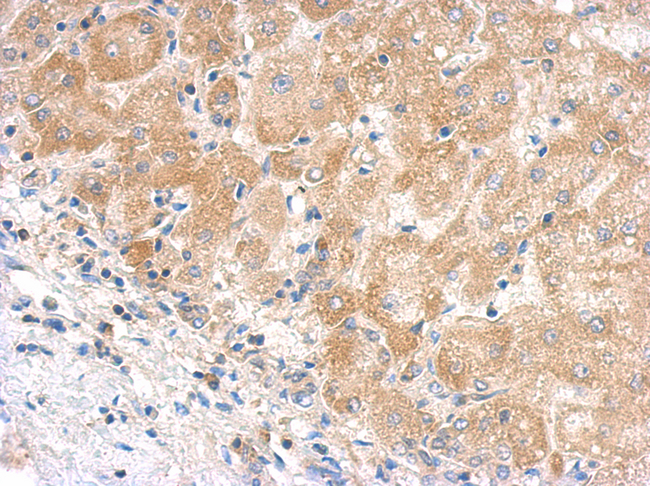 Complement C5 Antibody - IHC of paraffin-embedded hepatoma using C5 antibody antibody at 1:500 dilution.