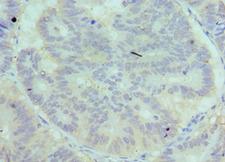 Complement C7 Antibody - Immunohistochemistry of paraffin-embedded human colon cancer using antibody at 1:100 dilution.