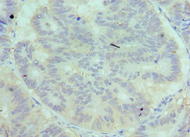 Complement C7 Antibody - Immunohistochemistry of paraffin-embedded human colon cancer using C7 Antibody at dilution of 1:100