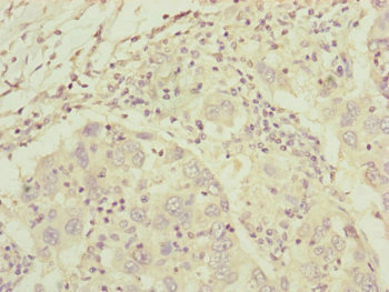 Complement C8A Antibody - Immunohistochemistry of paraffin-embedded human liver cancer at dilution of 1:100