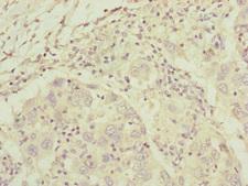 Complement C8A Antibody - Immunohistochemistry of paraffin-embedded human liver cancer at dilution of 1:100