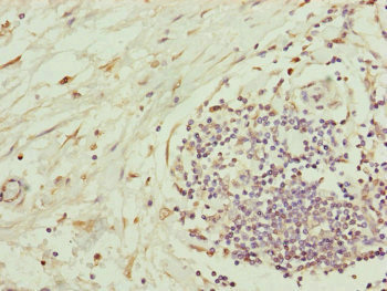 Complement C8b Antibody - Immunohistochemistry of paraffin-embedded human pancreatic cancer at dilution of 1:100