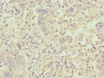 Complement C8b Antibody - Immunohistochemistry of paraffin-embedded human liver cancer at dilution of 1:100