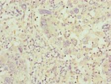 Complement C8b Antibody - Immunohistochemistry of paraffin-embedded human liver cancer at dilution of 1:100