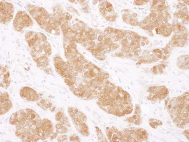 COMT Antibody - Detection of Human COMT by Immunohistochemistry. Sample: FFPE section of human breast carcinoma. Antibody: Affinity purified rabbit anti-COMT used at a dilution of 1:1000 (1 ug/ml). Detection: DAB.