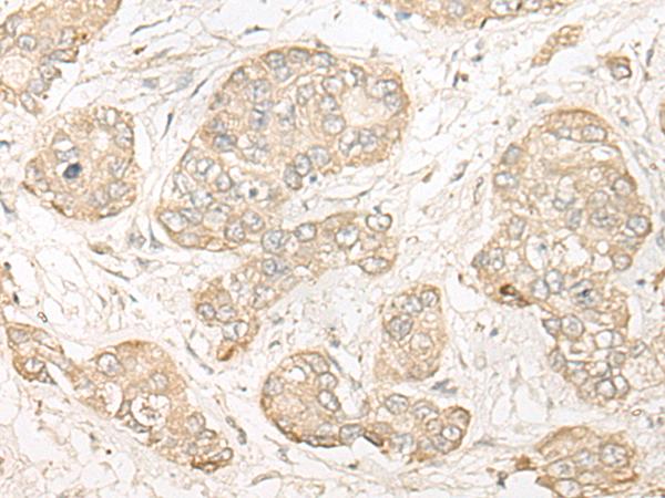 COMT Antibody - Immunohistochemistry of paraffin-embedded Human liver cancer tissue  using COMT Polyclonal Antibody at dilution of 1:30(×200)