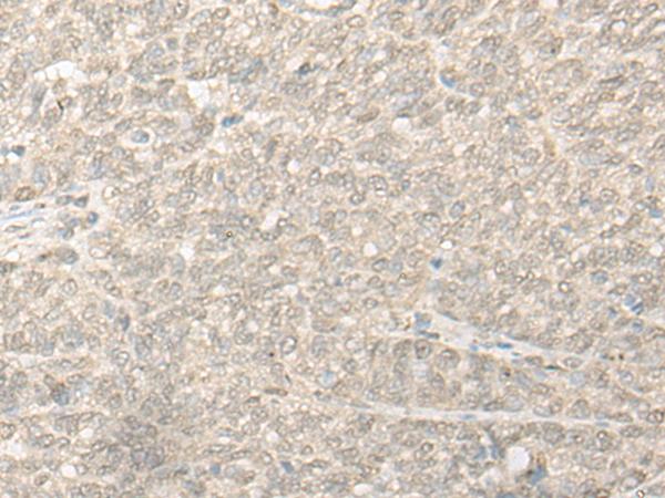 COMT Antibody - Immunohistochemistry of paraffin-embedded Human ovarian cancer tissue  using COMT Polyclonal Antibody at dilution of 1:30(×200)
