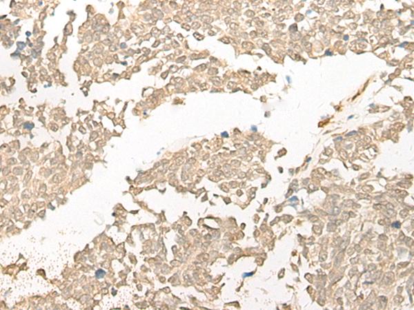 COMT Antibody - Immunohistochemistry of paraffin-embedded Human lung cancer tissue  using COMT Polyclonal Antibody at dilution of 1:25(×200)